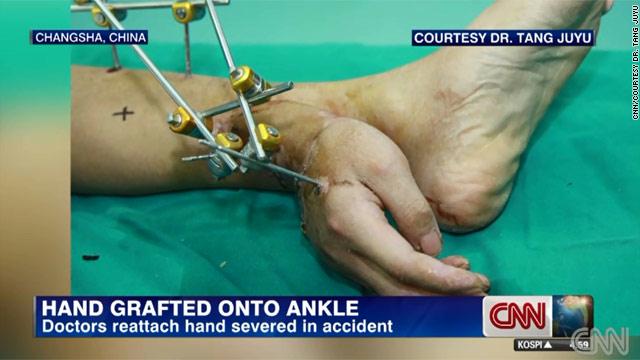 Photo of انقاذ يد عامل قطعتها إحدي الماكينات عبر زرعها بكاحل قدمة في الصين  والعملية تنجح للمرة العشرين !